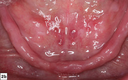 Implant Overdentures: The Right Treatment | Glidewell