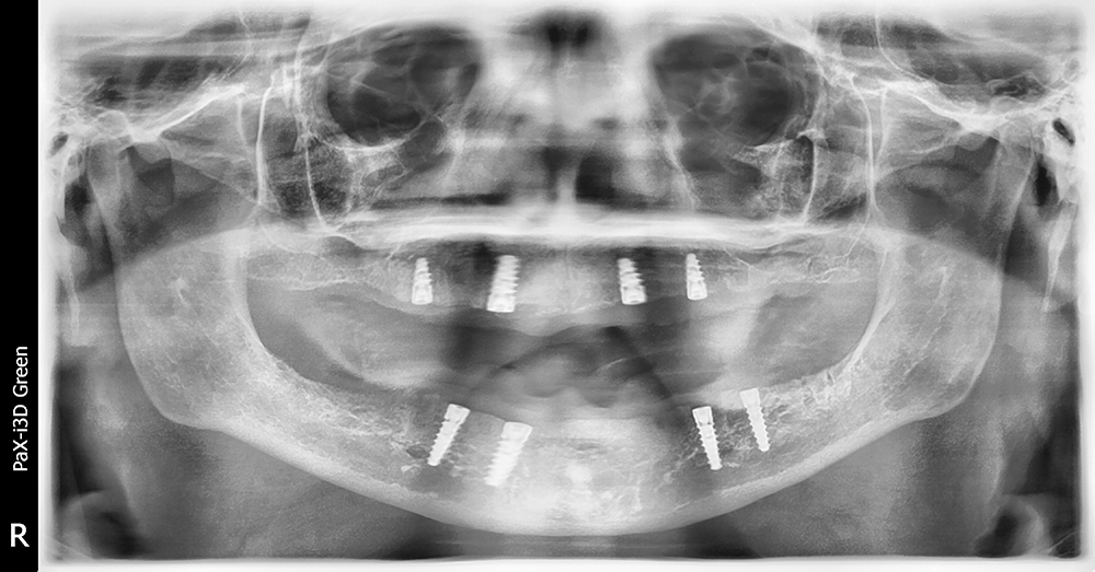 Figure 4 - Post operative radiograph with Hahn implants - V15I2