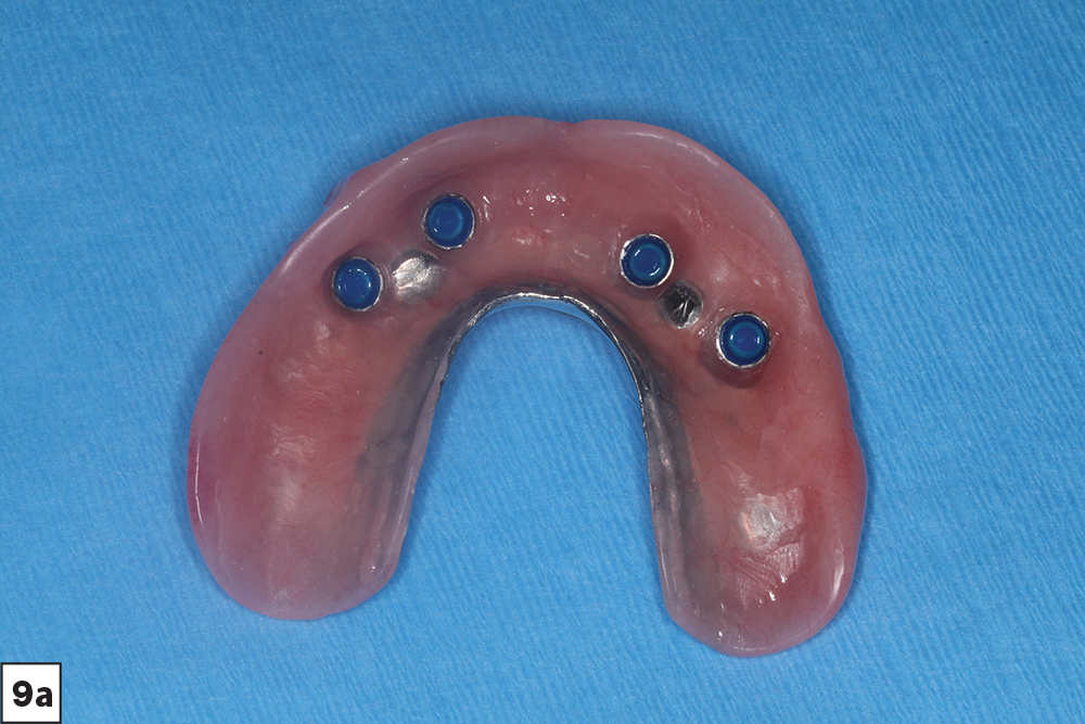 Implant Overdentures The Right Treatment Glidewell