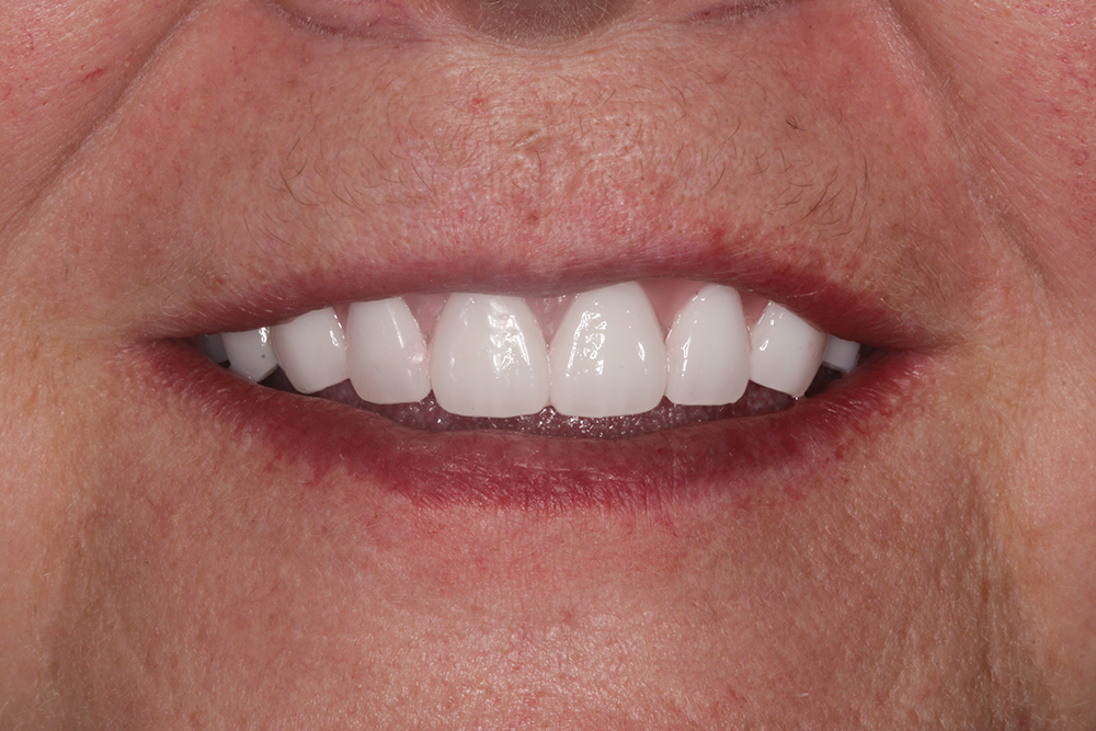 Figure 8 - Patient smile with trial denture setups - V15I2