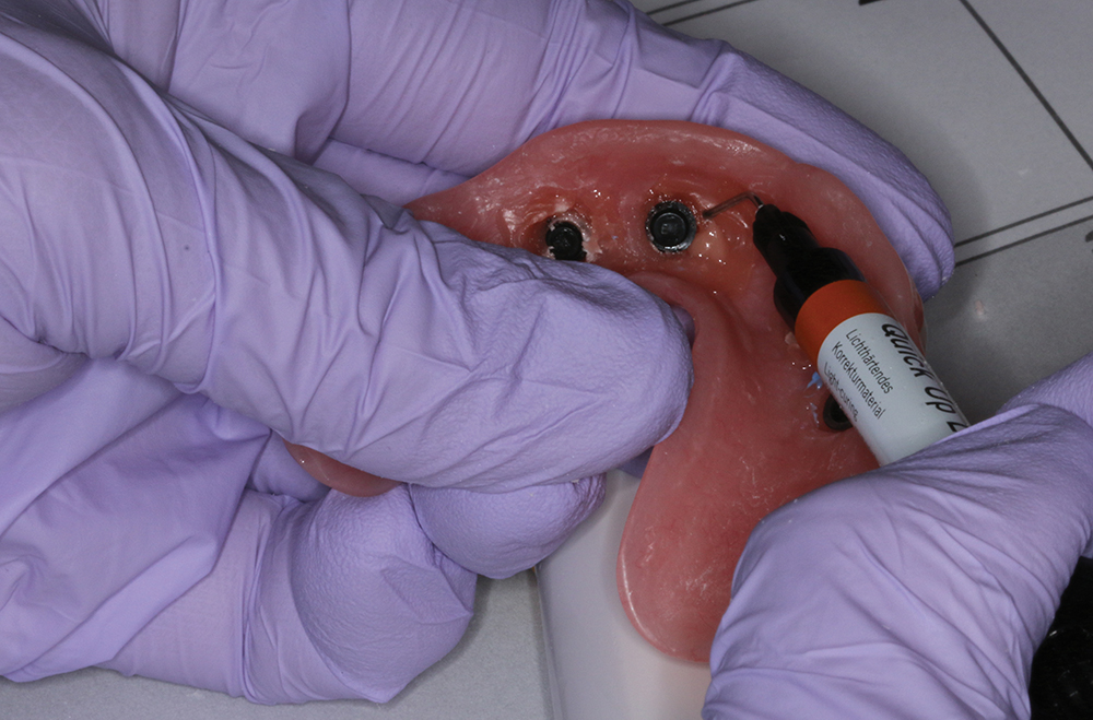 Implant Overdentures The Right Treatment Glidewell