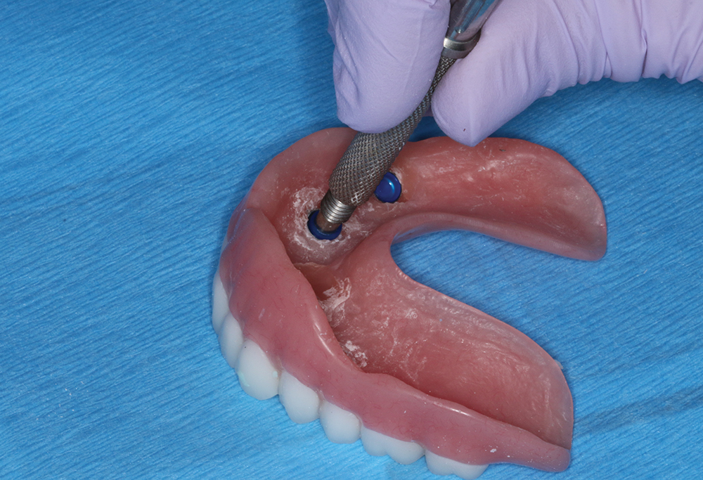 Implant Overdentures The Right Treatment Glidewell