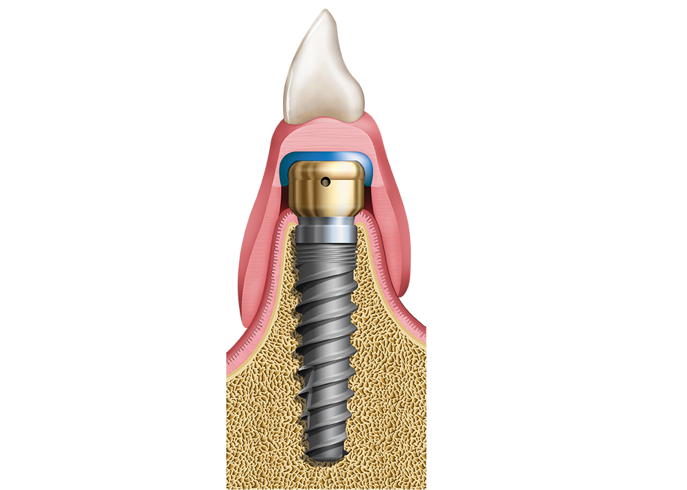 Implant Overdentures The Right Treatment Glidewell