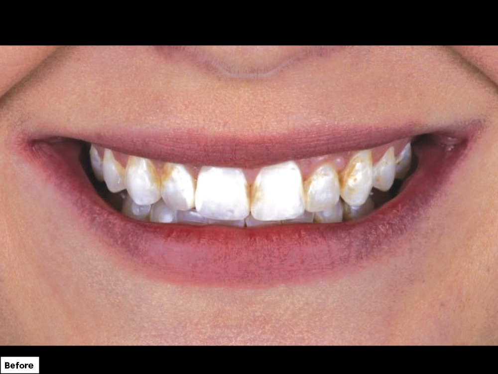 Close-up of patient's teeth before bruxzir esthetic