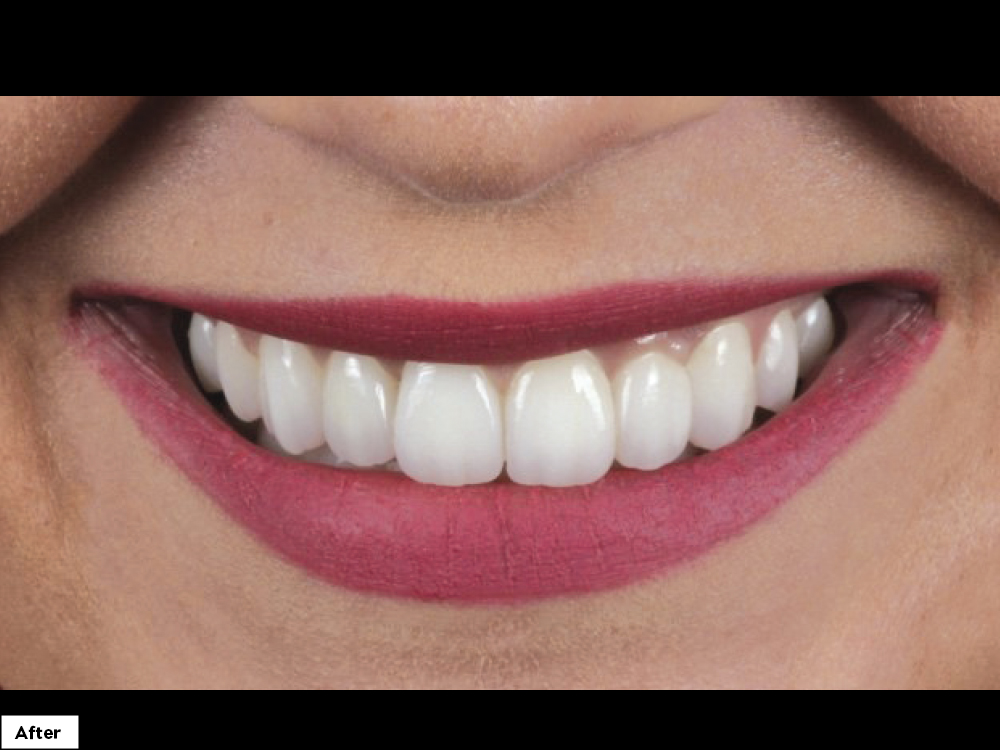 Close-up of patient's teeth after bruxzir esthetic