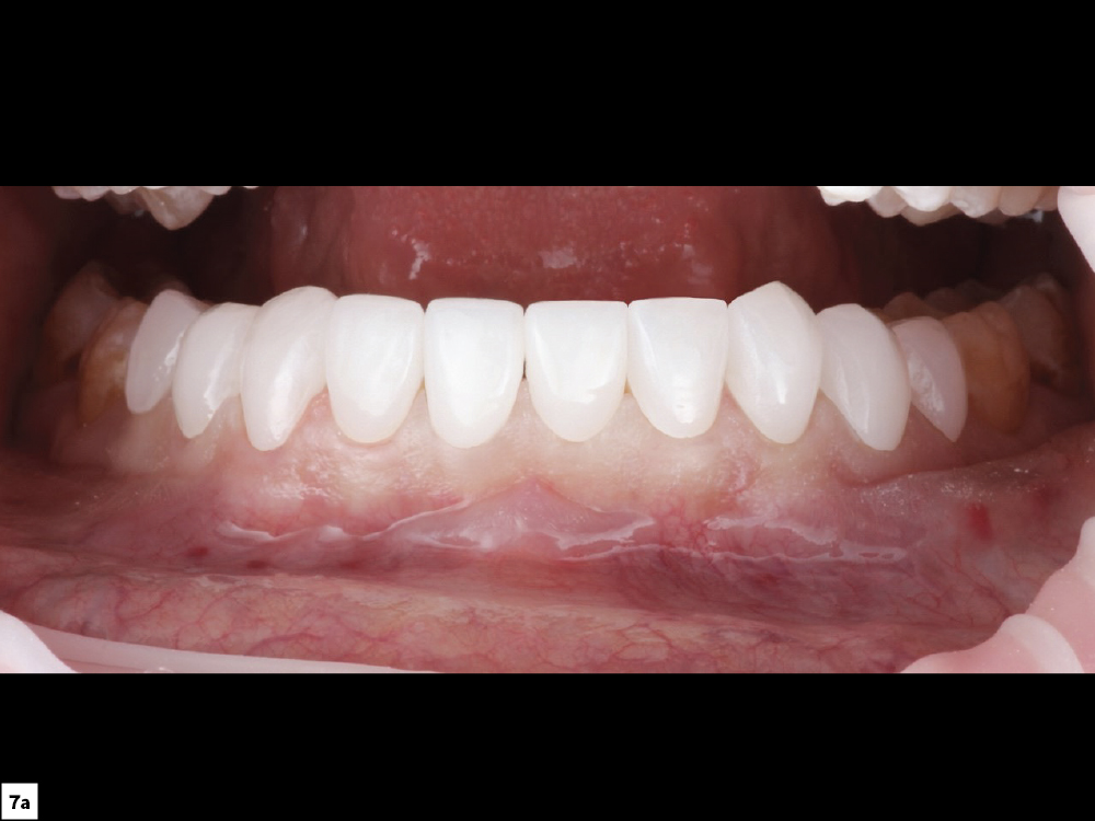 7a - Inside of mouth before restorations