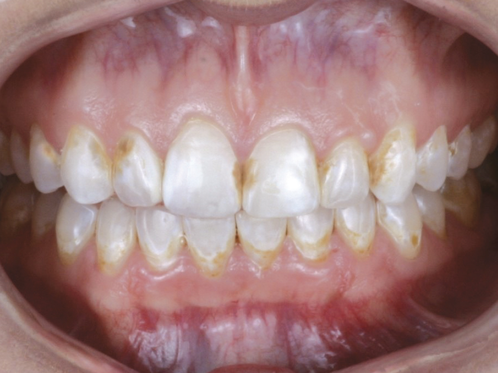 Patient presented with fluorosis, staining, decalcification and dental caries