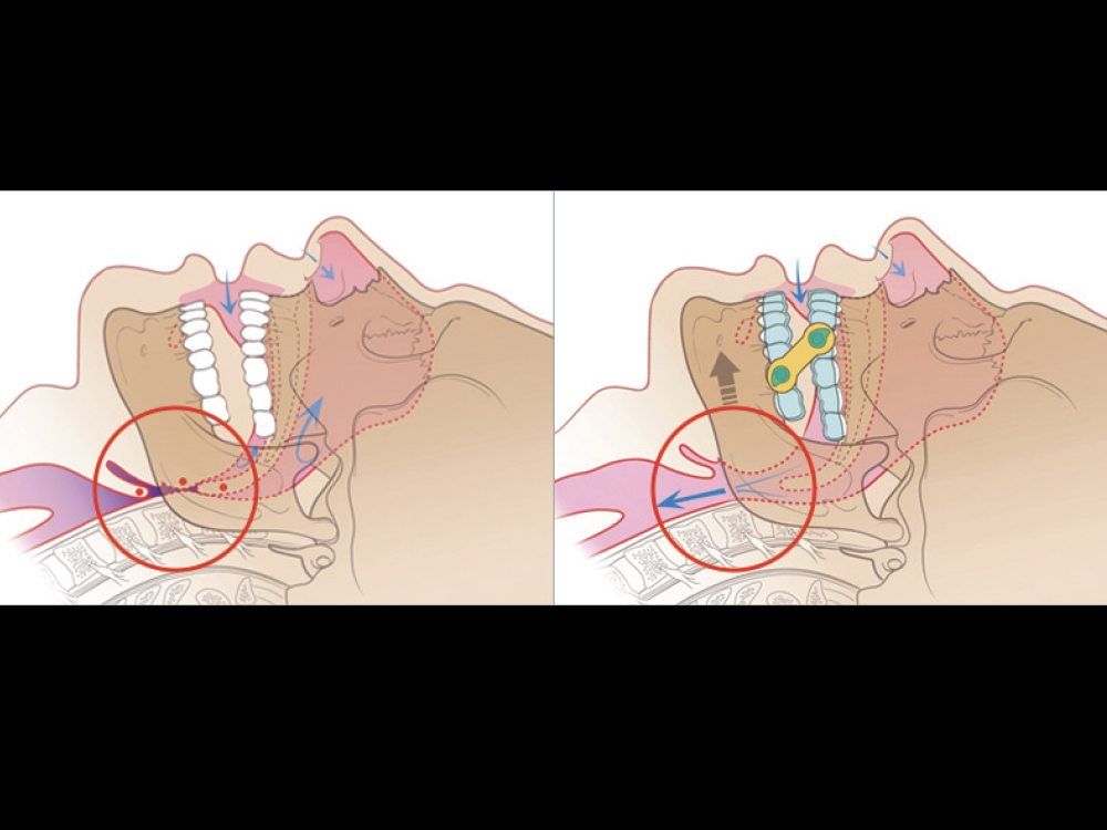 Without the EMA, the patient’s airway is obstructed by soft tissues (left). With the EMA, air is able to flow freely through the patient’s airway (right).