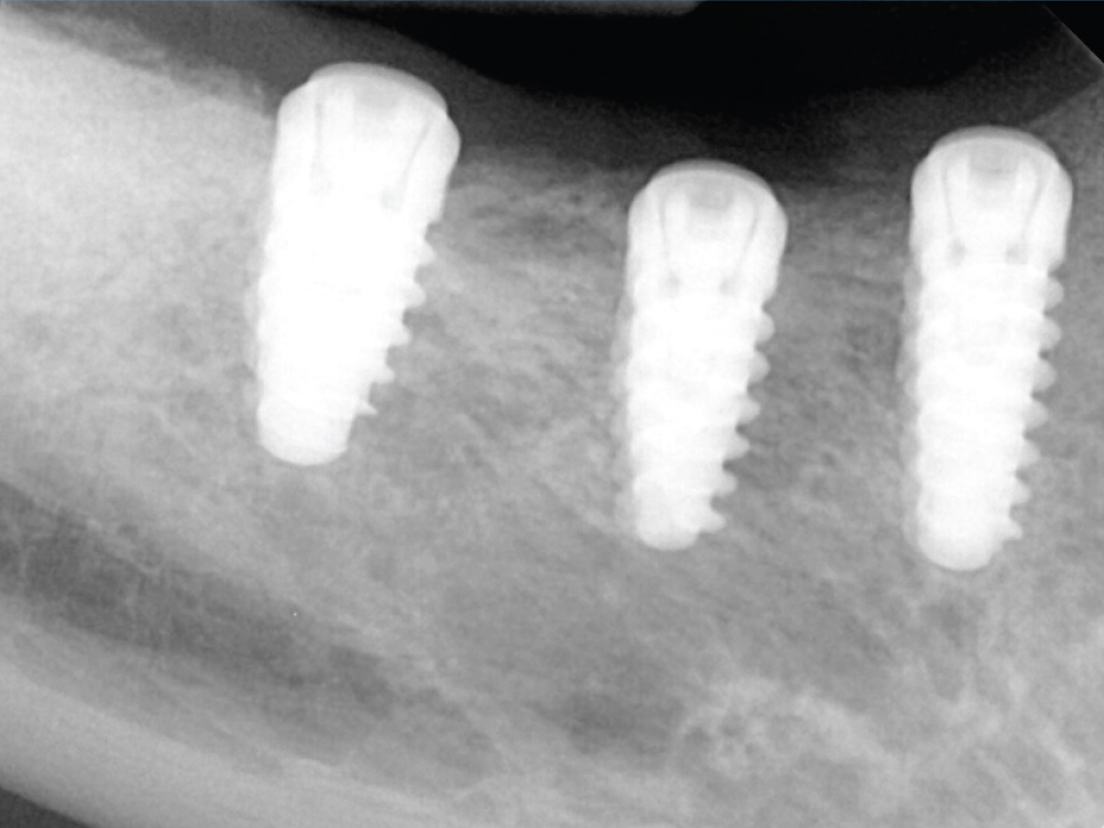 X-ray of 3 implants