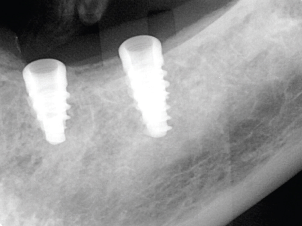 X-ray of 2 implants