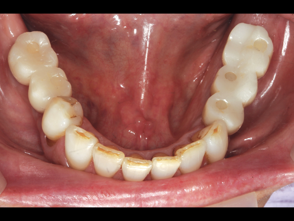 Final result of screw-retained restorations on teeth