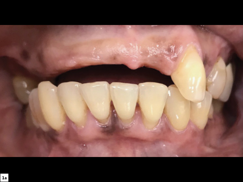 A previous removable partial denture of a patient