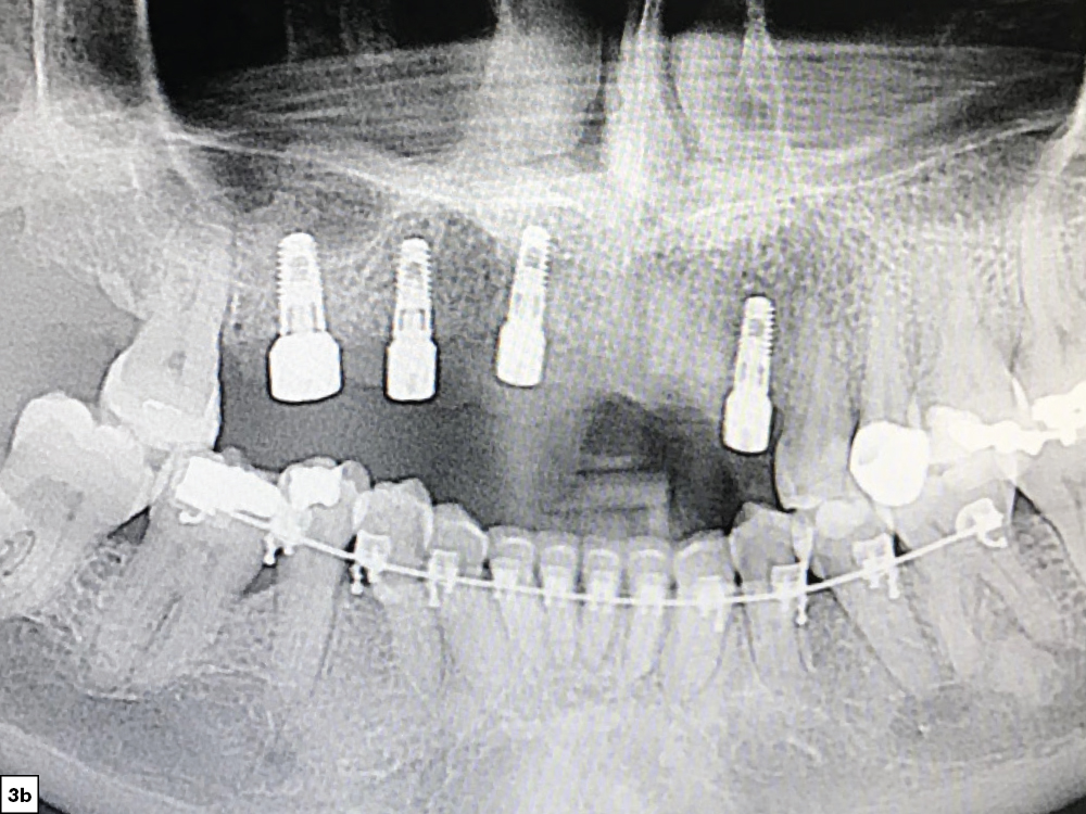 x-rays exhibited sufficient bone volume for implant placement