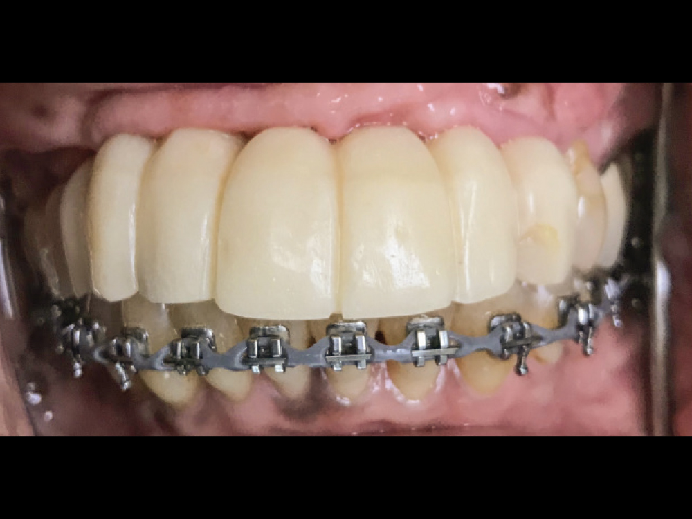 3 months after implant placement, screw-retained provisional implant prosthesis were added