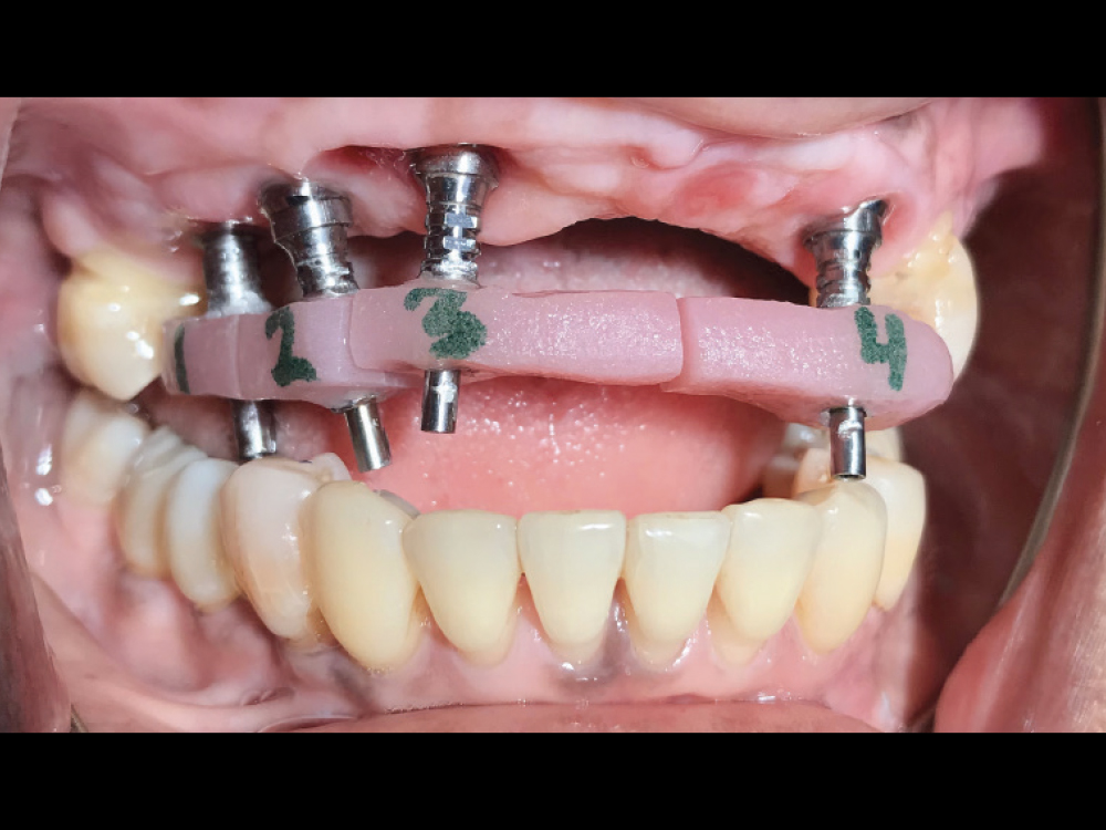 implant verification jig connected to implants and splinted together