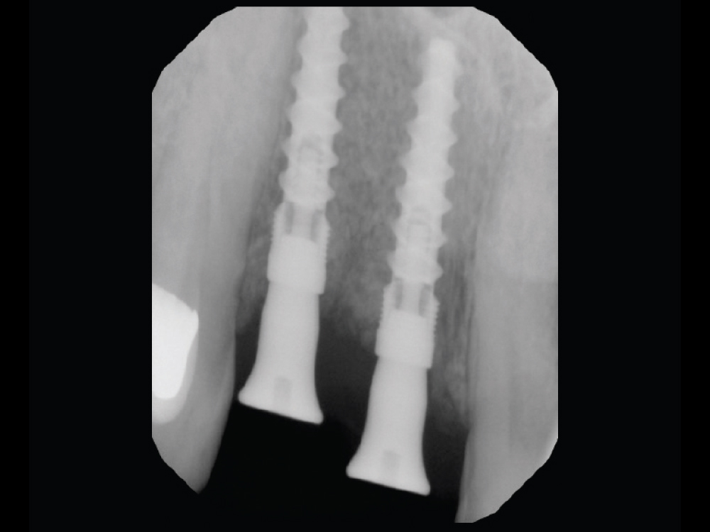 Hahn Tapered Implant Visual