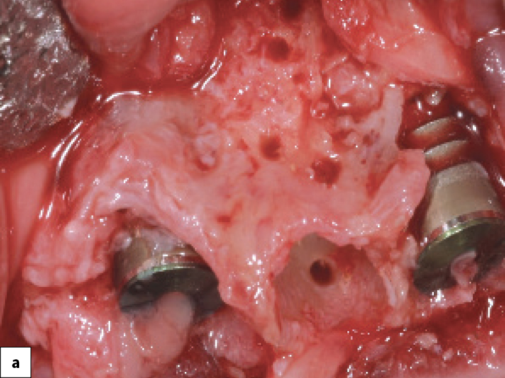 Implant Placement in Bony Defects