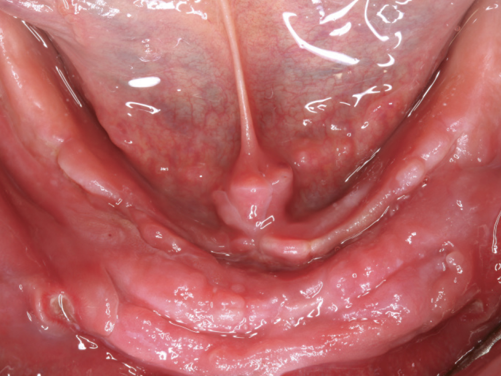 Excess tissue growth from poorly fitted mandibular denture