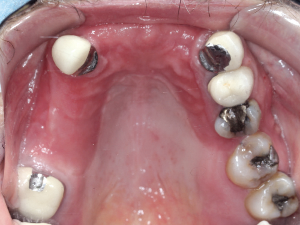 Fungal infection and inflammation from partial denture 