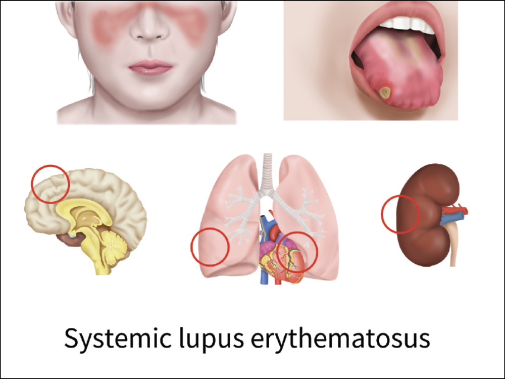 System lupus erythematosus