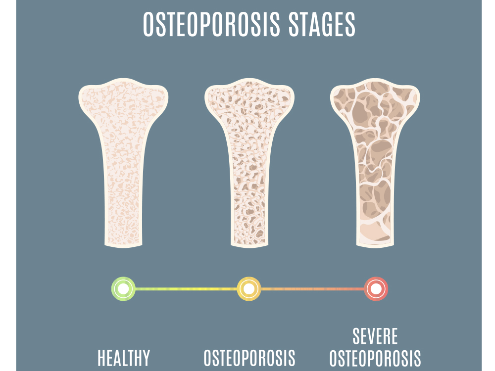 Healthy vs. severe osteoporosis