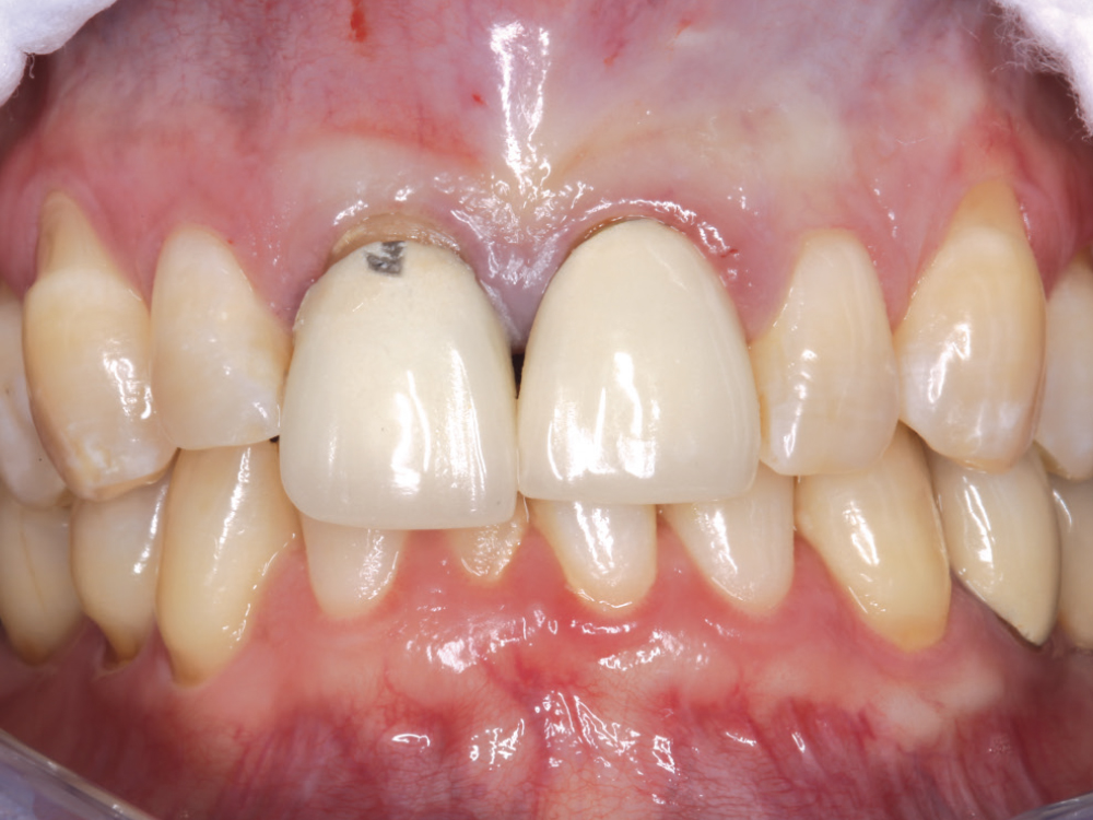 Endodontically treated tooth