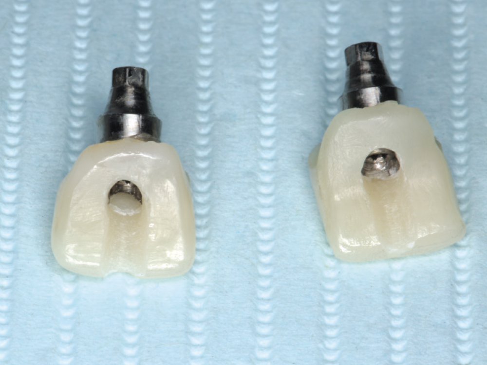 Screw-retained crowns
