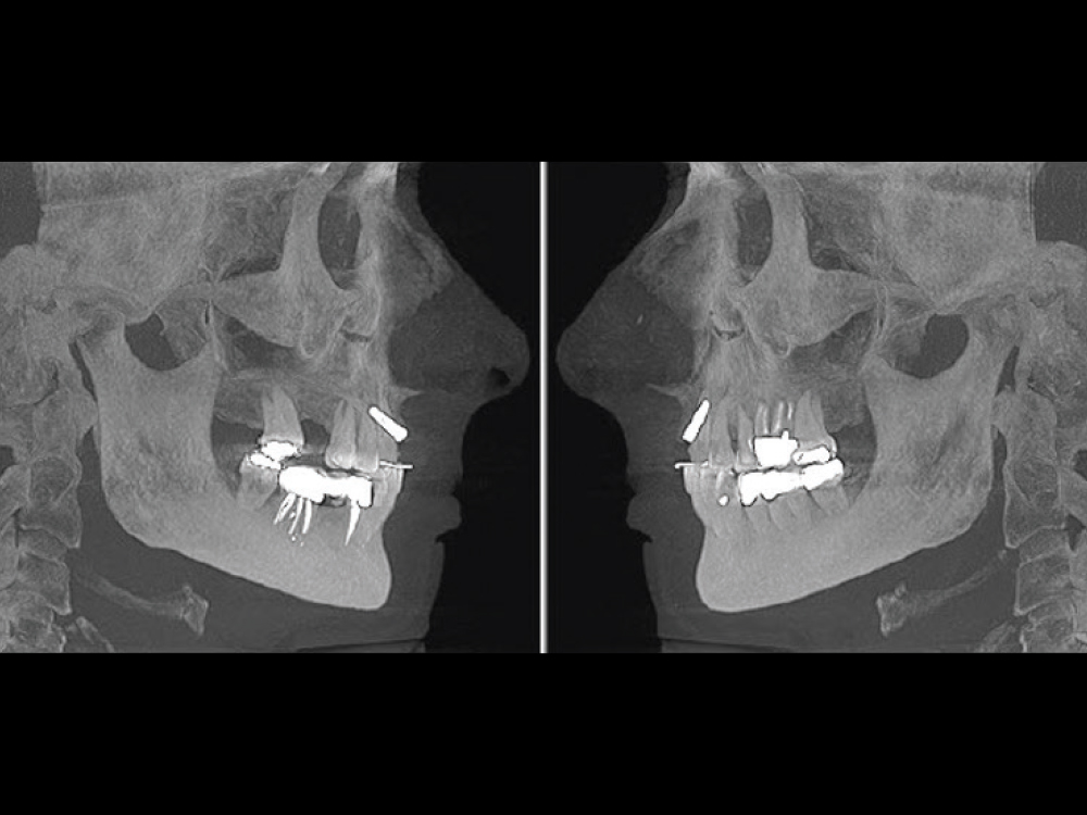 Patient side-by-side scan of exposed implants