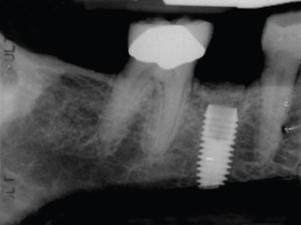 CBCT scan of implant