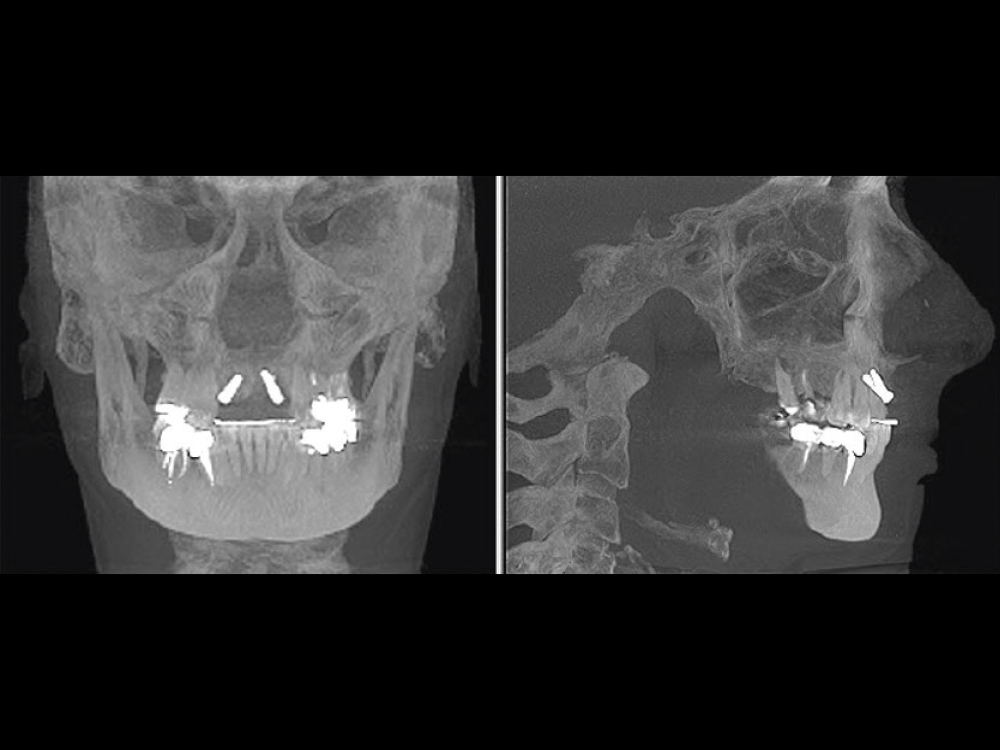 Patient front-side scan of exposed implants