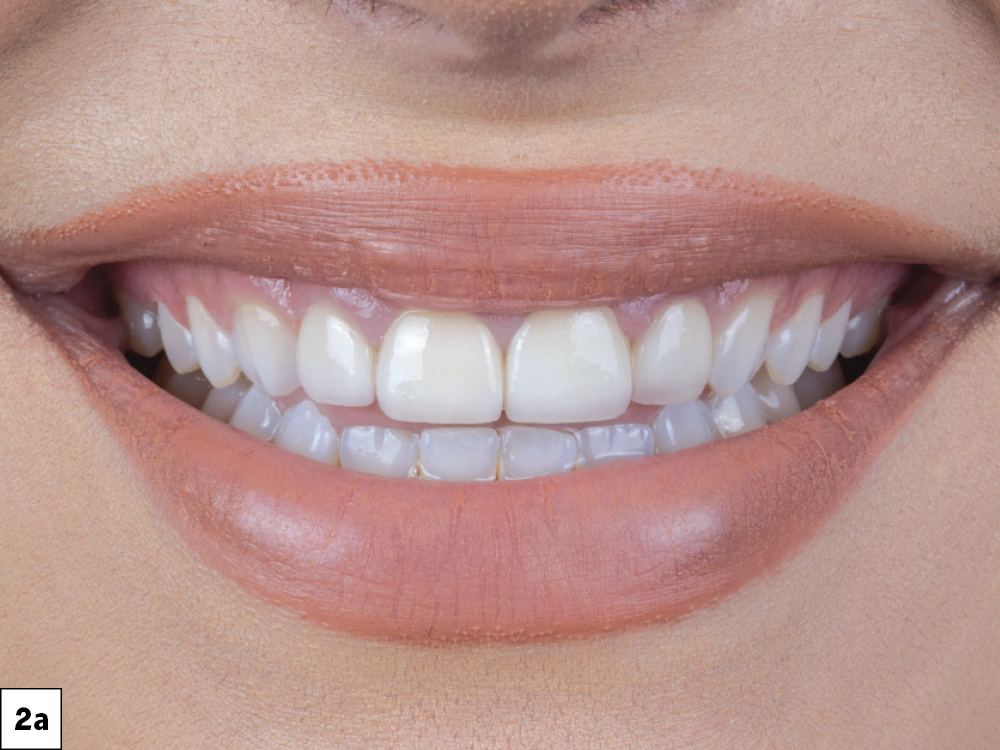 Esthetic Dentistry A 'Redo' Case