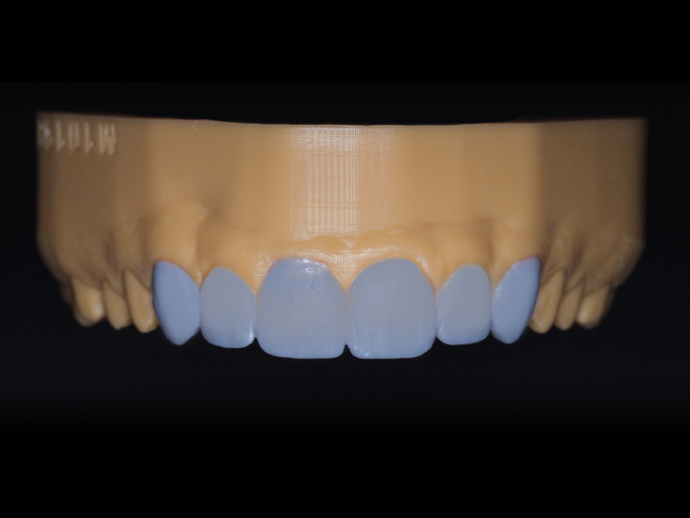 Esthetic Dentistry A 'Redo' Case