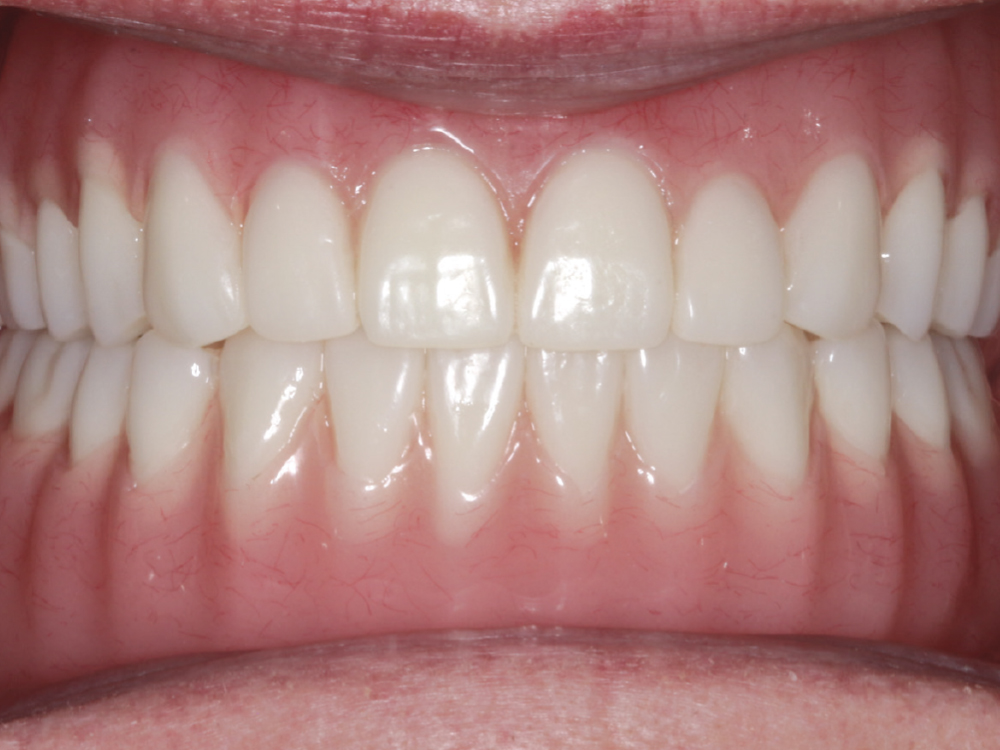 Implant Bar Overdentures Case Report