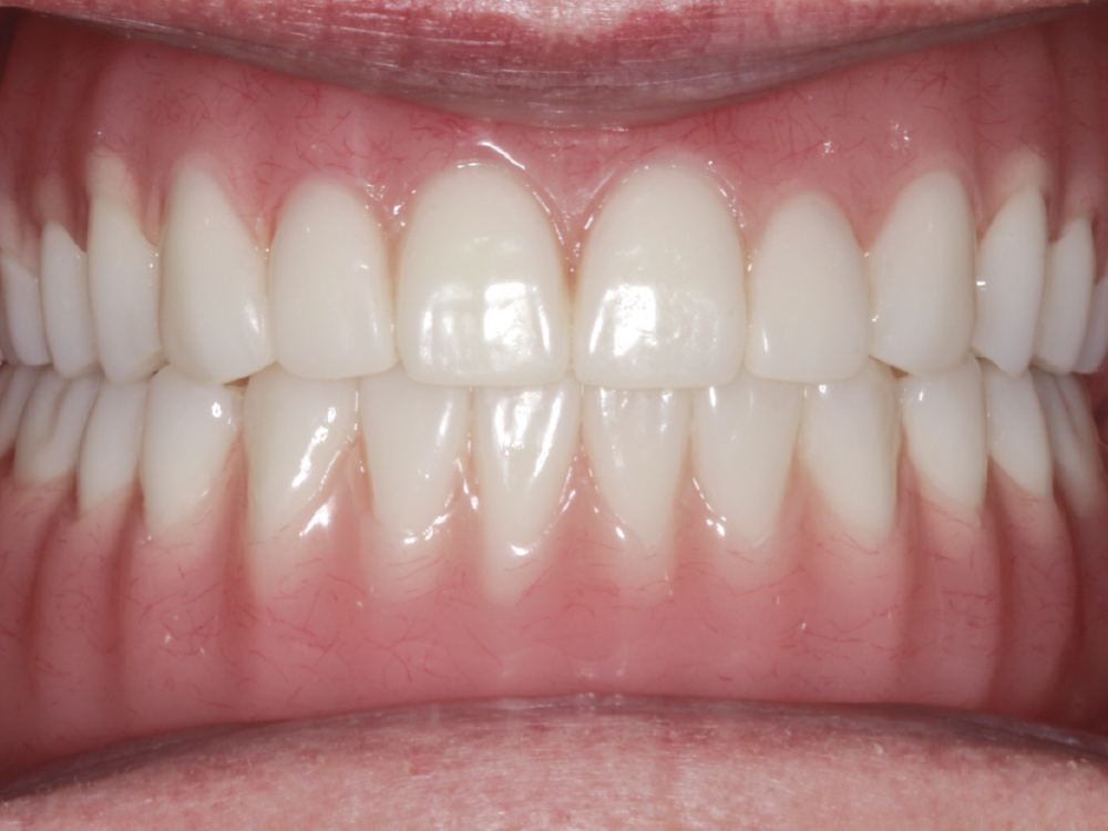 Implant overdenture front-view