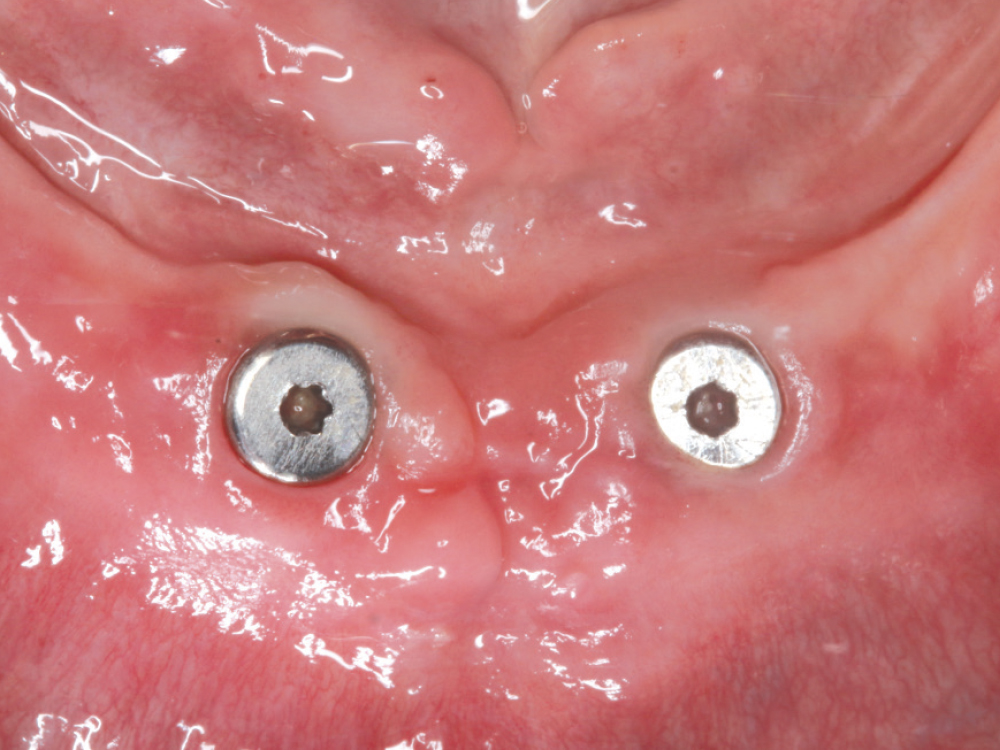 Hahn™ Tapered Implants placed in anterior