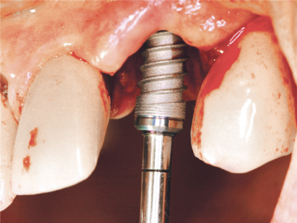 An implant being placed into gums
