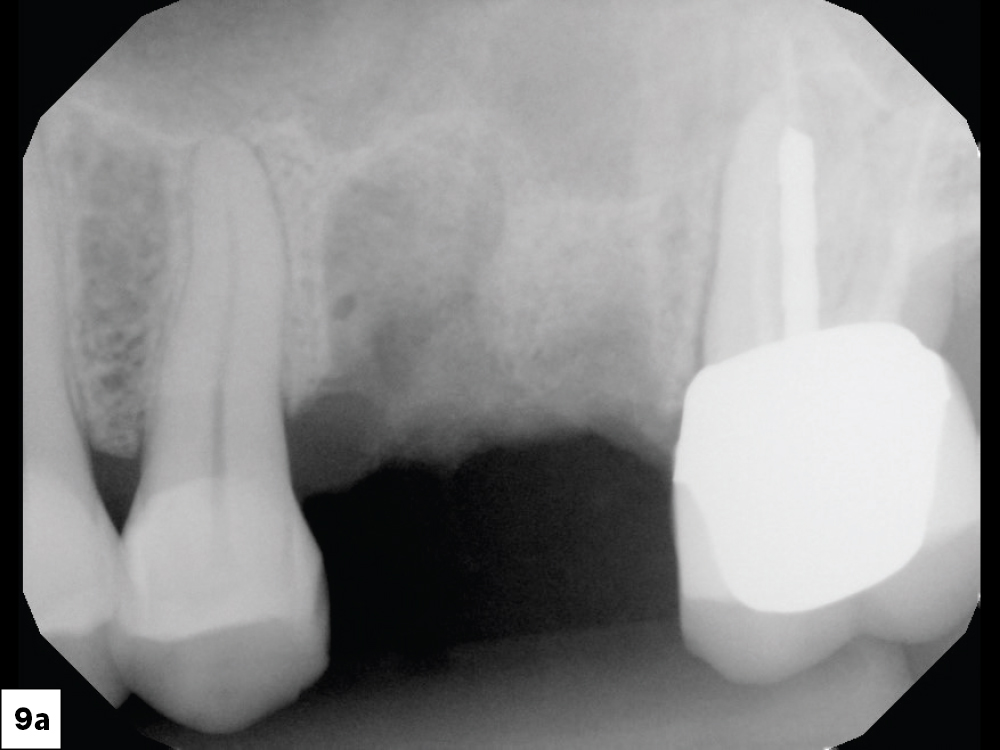Preoperative digital radiograph of an endodontically treated maxillary first molar