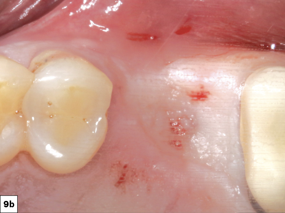 Figure 9b Replacement of a Maxillary First Molar CSM V16I3