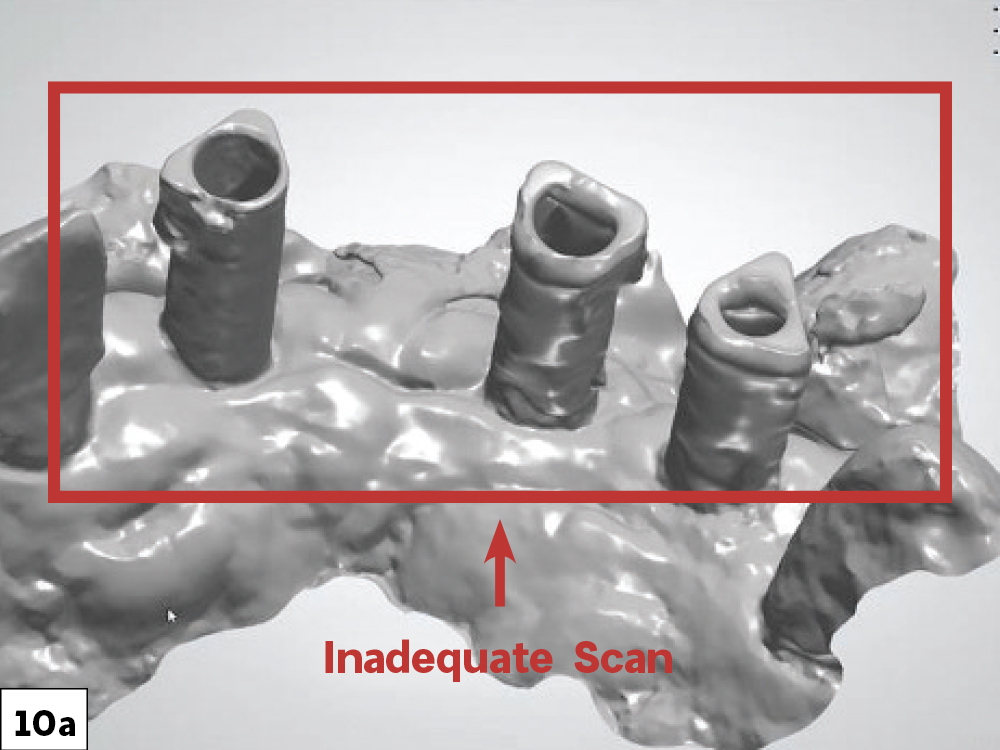 4 Steps to Capture Accurate Digital Dental Impressions