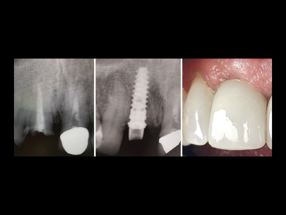 Image results of Dr. Oakey's Hahn Tapered Implant placement