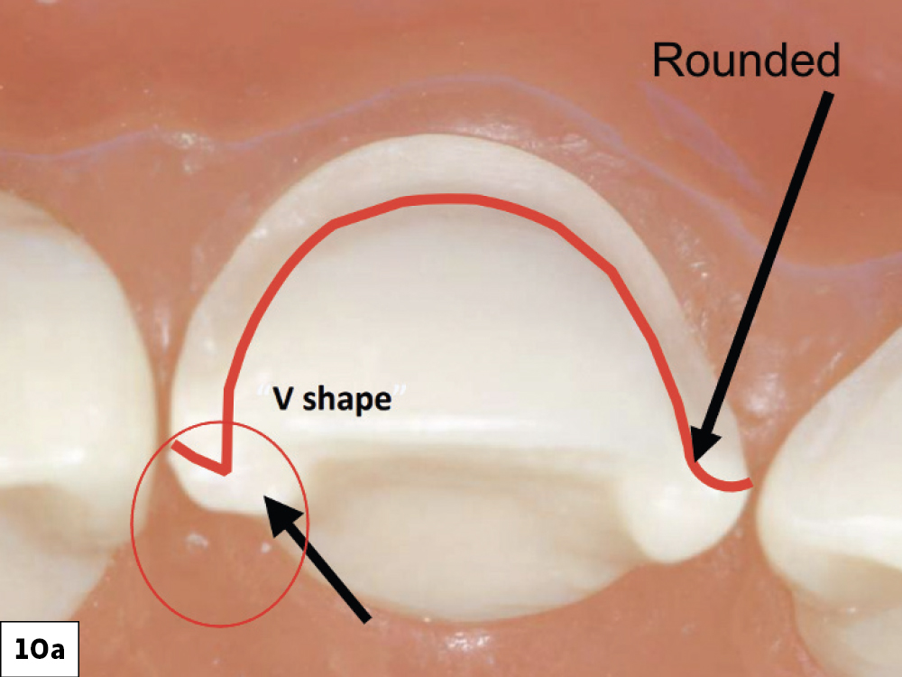 Veneer Preparation and Temporization Tips and Techniques