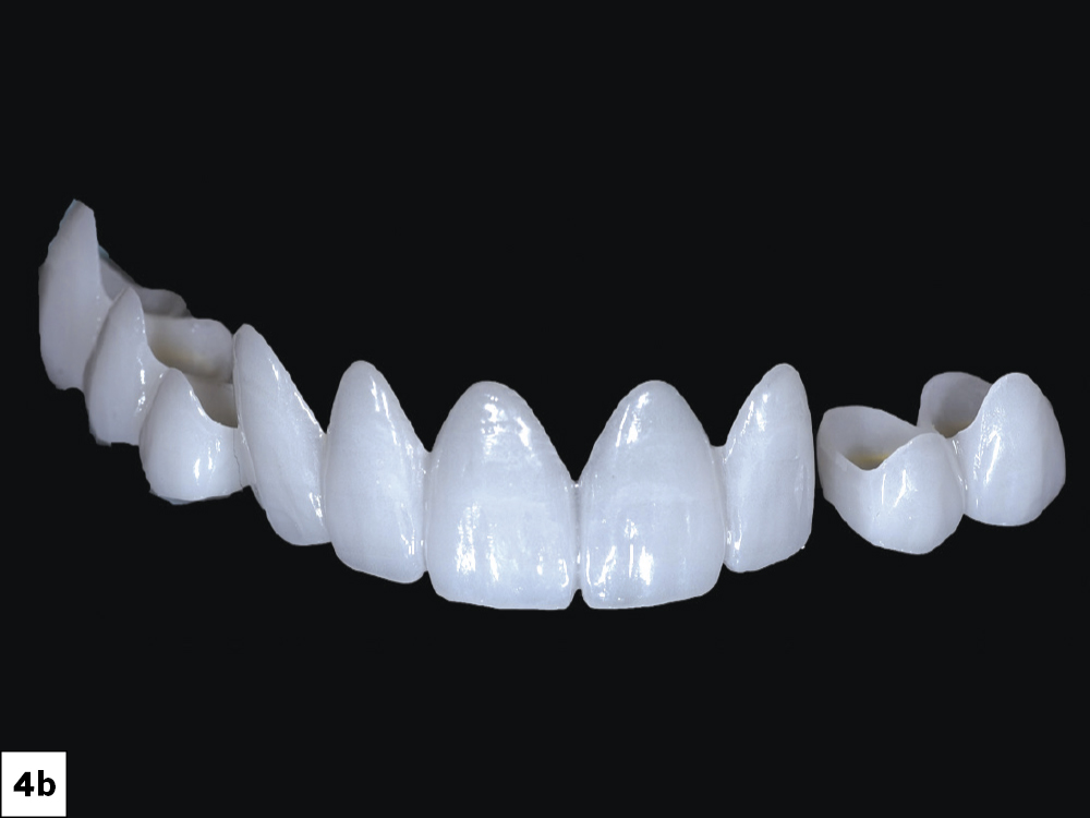 Veneer Preparation and Temporization Tips and Techniques