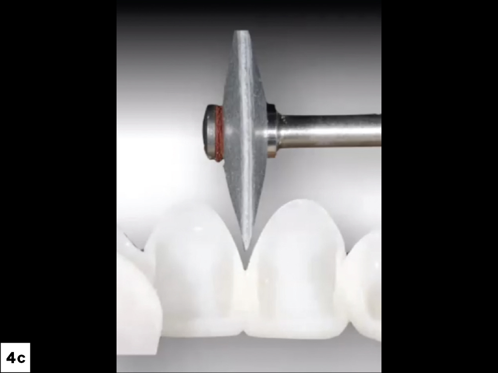 Veneer Preparation and Temporization Tips and Techniques