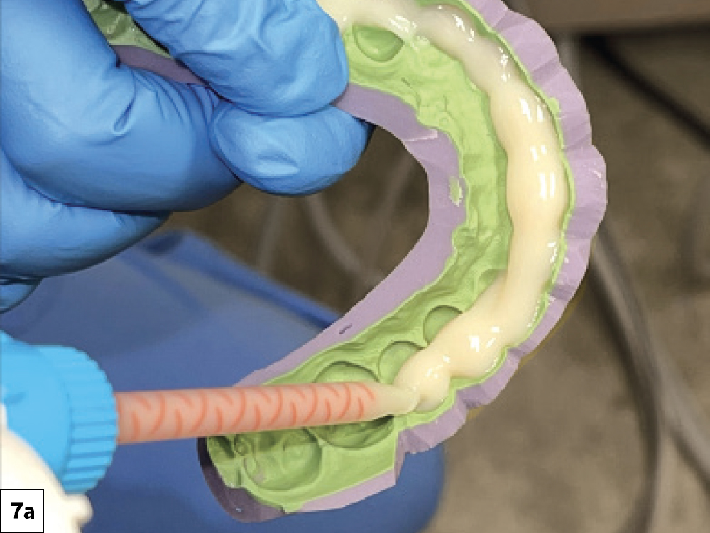 Veneer Preparation and Temporization Tips and Techniques