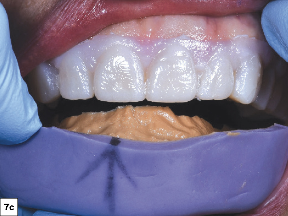 Veneer Preparation and Temporization Tips and Techniques