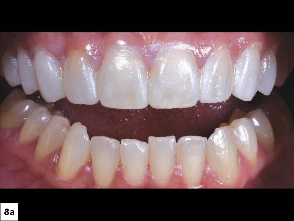 Veneer Preparation and Temporization Tips and Techniques