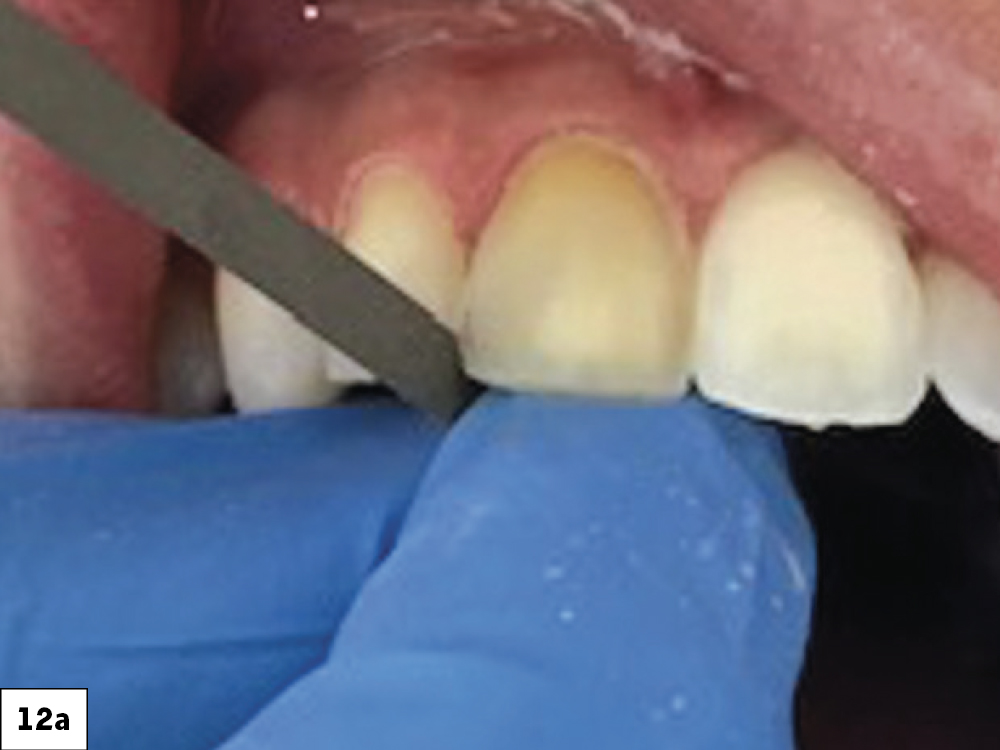 Veneer Preparation and Temporization Tips and Techniques