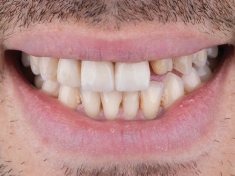 Male patient frontal teeth prior to crown