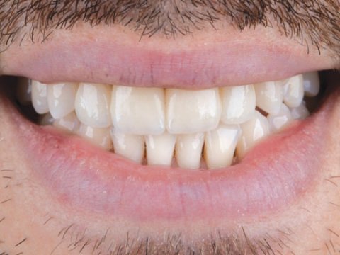 Male patient front teeth after lifelike crown added