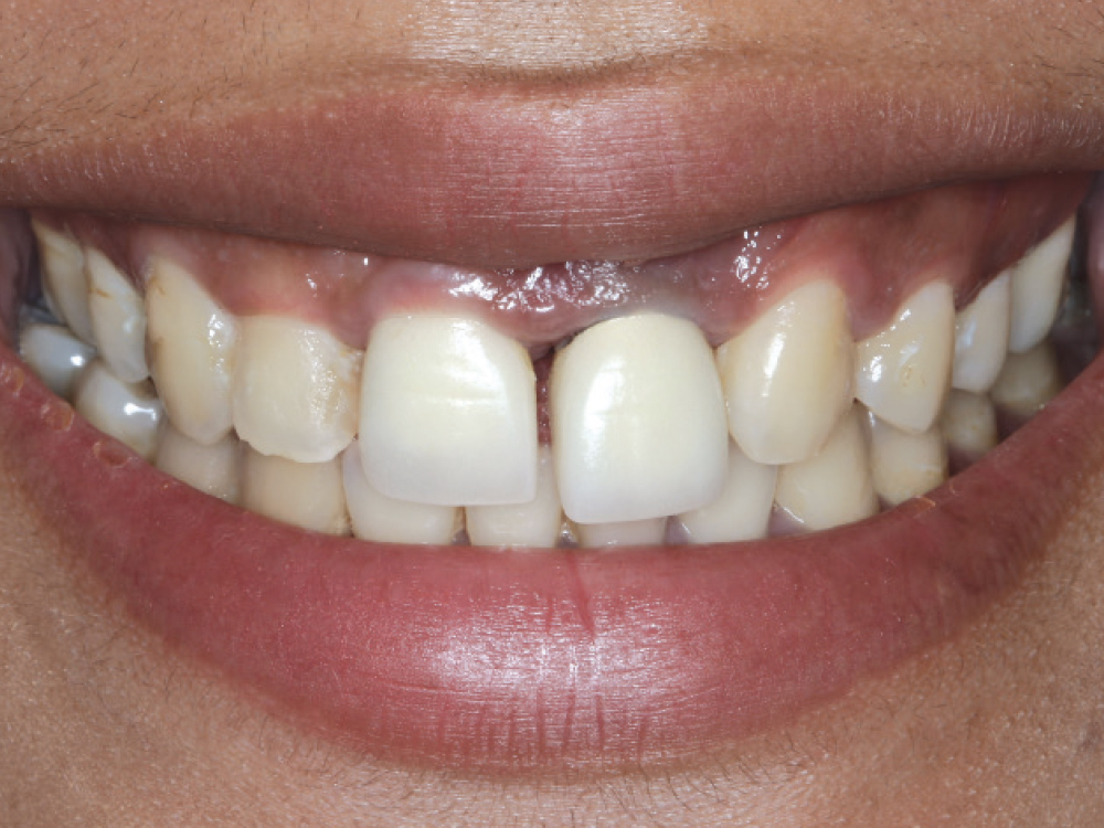 Close up of front tooth prior to dental bridge removal